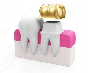 dentist-crown.jpg